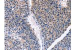 The image on the left is immunohistochemistry of paraffin-embedded Human liver cancer tissue using CSB-PA125315(CDK2 Antibody) at dilution 1/30, on the right is treated with fusion protein. (Original magnification: 