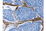 The image on the left is immunohistochemistry of paraffin-embedded Human lung cancer tissue using CSB-PA125350(COL3A1 Antibody) at dilution 1/60, on the right is treated with fusion protein. (Original magnification: 