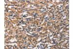 The image on the left is immunohistochemistry of paraffin-embedded Human thyroid cancer tissue using CSB-PA125715(CDC23 Antibody) at dilution 1/70, on the right is treated with synthetic peptide. (Original magnification: 