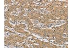The image on the left is immunohistochemistry of paraffin-embedded Human gastic cancer tissue using CSB-PA126192(AMZ2 Antibody) at dilution 1/60, on the right is treated with fusion protein. (Original magnification: 