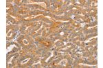 The image on the left is immunohistochemistry of paraffin-embedded Human thyroid cancer tissue using CSB-PA126362(CD2AP Antibody) at dilution 1/70, on the right is treated with synthetic peptide. (Original magnification: 