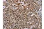 The image on the left is immunohistochemistry of paraffin-embedded Human liver cancer tissue using CSB-PA126562(ERRFI1 Antibody) at dilution 1/35, on the right is treated with synthetic peptide. (Original magnification: 