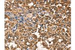 The image on the left is immunohistochemistry of paraffin-embedded Human thyroid cancer tissue using CSB-PA126592(AGO1 Antibody) at dilution 1/40, on the right is treated with synthetic peptide. (Original magnification: 