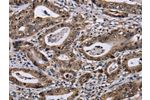 The image on the left is immunohistochemistry of paraffin-embedded Human gastic cancer tissue using CSB-PA126732(DUSP4 Antibody) at dilution 1/40, on the right is treated with fusion protein. (Original magnification: 