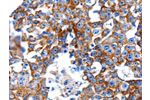 The image on the left is immunohistochemistry of paraffin-embedded Human breast cancer tissue using CSB-PA126836(CLEC7A Antibody) at dilution 1/5, on the right is treated with fusion protein. (Original magnification: 