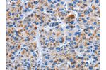 The image on the left is immunohistochemistry of paraffin-embedded Human liver cancer tissue using CSB-PA127200(CENPJ Antibody) at dilution 1/40, on the right is treated with fusion protein. (Original magnification: 