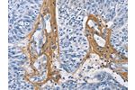 The image on the left is immunohistochemistry of paraffin-embedded Human ovarian cancer tissue using CSB-PA127242(COL3A1 Antibody) at dilution 1/60, on the right is treated with fusion protein. (Original magnification: 