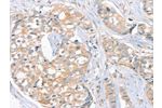 The image on the left is immunohistochemistry of paraffin-embedded Human breast cancer tissue using CSB-PA127416(FAIM3 Antibody) at dilution 1/20, on the right is treated with fusion protein. (Original magnification: 