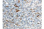 The image on the left is immunohistochemistry of paraffin-embedded Human gastic cancer tissue using CSB-PA127583(ABCG1 Antibody) at dilution 1/40, on the right is treated with synthetic peptide. (Original magnification: 
