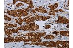 The image on the left is immunohistochemistry of paraffin-embedded Human breast cancer tissue using CSB-PA127808(COX6B2 Antibody) at dilution 1/35, on the right is treated with fusion protein. (Original magnification: 