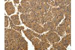 The image on the left is immunohistochemistry of paraffin-embedded Human liver cancer tissue using CSB-PA127898(EIF2AK3 Antibody) at dilution 1/40, on the right is treated with fusion protein. (Original magnification: 