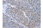The image on the left is immunohistochemistry of paraffin-embedded Human liver cancer tissue using CSB-PA128187(BTG2 Antibody) at dilution 1/35, on the right is treated with fusion protein. (Original magnification: 