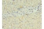 Immunohistochemistry of paraffin-embedded human liver cancer using CSB-PA12847A0Rb at dilution 1:100