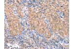 The image on the left is immunohistochemistry of paraffin-embedded Human cervical cancer tissue using CSB-PA129011(ACADS Antibody) at dilution 1/15, on the right is treated with fusion protein. (Original magnification: 