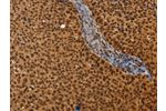The image on the left is immunohistochemistry of paraffin-embedded Human cervical cancer tissue using CSB-PA129151(CEL Antibody) at dilution 1/40, on the right is treated with synthetic peptide. (Original magnification: 