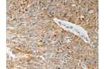 The image on the left is immunohistochemistry of paraffin-embedded Human ovarian cancer tissue using CSB-PA129196(COL4A3 Antibody) at dilution 1/20, on the right is treated with synthetic peptide. (Original magnification: 