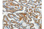 The image on the left is immunohistochemistry of paraffin-embedded Human thyroid cancer tissue using CSB-PA129399(BCAT2 Antibody) at dilution 1/50, on the right is treated with fusion protein. (Original magnification: 