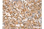 The image on the left is immunohistochemistry of paraffin-embedded Human thyroid cancer tissue using CSB-PA129519(CRKL Antibody) at dilution 1/25, on the right is treated with synthetic peptide. (Original magnification: 