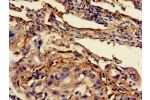 Immunohistochemistry of paraffin-embedded human lung cancer using CSB-PA12959A0Rb at dilution of 1:100
