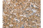 The image on the left is immunohistochemistry of paraffin-embedded Human thyroid cancer tissue using CSB-PA129637(FASLG Antibody) at dilution 1/30, on the right is treated with synthetic peptide. (Original magnification: 