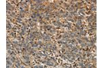 The image on the left is immunohistochemistry of paraffin-embedded Human liver cancer tissue using CSB-PA129669(ARF6 Antibody) at dilution 1/30, on the right is treated with synthetic peptide. (Original magnification: 