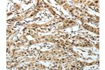 The image on the left is immunohistochemistry of paraffin-embedded Human lung cancer tissue using CSB-PA129862(FZD3 Antibody) at dilution 1/20, on the right is treated with synthetic peptide. (Original magnification: 