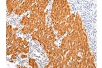 The image on the left is immunohistochemistry of paraffin-embedded Human gastric cancer tissue using CSB-PA129979(BSN Antibody) at dilution 1/20, on the right is treated with synthetic peptide. (Original magnification: 