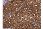 The image on the left is immunohistochemistry of paraffin-embedded Human cervical cancer tissue using CSB-PA130250(CYP2W1 Antibody) at dilution 1/60, on the right is treated with fusion protein. (Original magnification: 