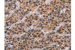 The image on the left is immunohistochemistry of paraffin-embedded Human liver cancer tissue using CSB-PA130815(CD80 Antibody) at dilution 1/25, on the right is treated with synthetic peptide. (Original magnification: 