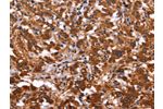 The image on the left is immunohistochemistry of paraffin-embedded Human thyroid cancer tissue using CSB-PA131138(ARL4A Antibody) at dilution 1/50, on the right is treated with fusion protein. (Original magnification: 