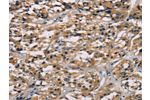 The image on the left is immunohistochemistry of paraffin-embedded Human thyroid cancer tissue using CSB-PA131153(CGA Antibody) at dilution 1/65, on the right is treated with fusion protein. (Original magnification: 