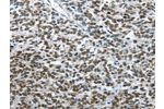 The image on the left is immunohistochemistry of paraffin-embedded Human ovarian cancer tissue using CSB-PA131190(ARL2 Antibody) at dilution 1/15, on the right is treated with fusion protein. (Original magnification: 