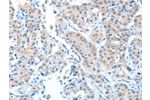 The image on the left is immunohistochemistry of paraffin-embedded Human lung cancer tissue using CSB-PA131728(ADAMTSL1 Antibody) at dilution 1/25, on the right is treated with fusion protein. (Original magnification: 
