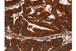 The image on the left is immunohistochemistry of paraffin-embedded Human colon cancer tissue using CSB-PA132284(GCKR Antibody) at dilution 1/50, on the right is treated with synthetic peptide. (Original magnification: 