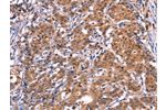 The image on the left is immunohistochemistry of paraffin-embedded Human gastic cancer tissue using CSB-PA132302(GCG Antibody) at dilution 1/40, on the right is treated with synthetic peptide. (Original magnification: 