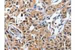 The image on the left is immunohistochemistry of paraffin-embedded Human lung cancer tissue using CSB-PA132342(DUSP8 Antibody) at dilution 1/40, on the right is treated with synthetic peptide. (Original magnification: 