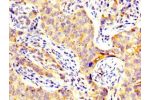 IHC image of CSB-PA13269A0Rb diluted at 1:300 and staining in paraffin-embedded human pancreatic cancer performed on a Leica BondTM system. After dewaxing and hydration, antigen retrieval was mediated by high pressure in a citrate buffer (pH 6.0). Section