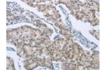 The image on the left is immunohistochemistry of paraffin-embedded Human breast cancer tissue using CSB-PA132836(FOXA1 Antibody) at dilution 1/50, on the right is treated with synthetic peptide. (Original magnification: 