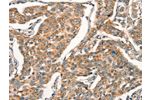 The image on the left is immunohistochemistry of paraffin-embedded Human breast cancer tissue using CSB-PA133087(ARFRP1 Antibody) at dilution 1/25, on the right is treated with synthetic peptide. (Original magnification: 