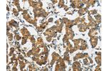 The image on the left is immunohistochemistry of paraffin-embedded Human breast cancer tissue using CSB-PA133408(FABP2 Antibody) at dilution 1/30, on the right is treated with fusion protein. (Original magnification: 