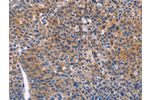 The image on the left is immunohistochemistry of paraffin-embedded Human liver cancer tissue using CSB-PA133439(ARRB1 Antibody) at dilution 1/50, on the right is treated with fusion protein. (Original magnification: 