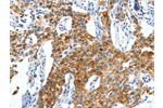 The image on the left is immunohistochemistry of paraffin-embedded Human lung cancer tissue using CSB-PA133590(CKAP4 Antibody) at dilution 1/50, on the right is treated with synthetic peptide. (Original magnification: 