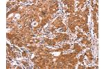 The image on the left is immunohistochemistry of paraffin-embedded Human gastic cancer tissue using CSB-PA134376(BCAR1 Antibody) at dilution 1/15, on the right is treated with synthetic peptide. (Original magnification: 