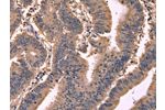 The image on the left is immunohistochemistry of paraffin-embedded Human colon cancer tissue using CSB-PA135172(GCG Antibody) at dilution 1/20, on the right is treated with synthetic peptide. (Original magnification: 