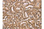 The image on the left is immunohistochemistry of paraffin-embedded Human thyroid cancer tissue using CSB-PA135204(BGLAP Antibody) at dilution 1/40, on the right is treated with synthetic peptide. (Original magnification: 