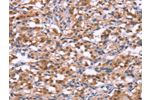 The image on the left is immunohistochemistry of paraffin-embedded Human thyroid cancer tissue using CSB-PA135237(BRK1 Antibody) at dilution 1/30, on the right is treated with synthetic peptide. (Original magnification: 