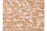 The image on the left is immunohistochemistry of paraffin-embedded Human liver cancer tissue using CSB-PA135485(GNA11 Antibody) at dilution 1/40, on the right is treated with fusion protein. (Original magnification: 