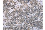 The image on the left is immunohistochemistry of paraffin-embedded Human cervical cancer tissue using CSB-PA135769(ESR2 Antibody) at dilution 1/30, on the right is treated with fusion protein. (Original magnification: 