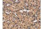 The image on the left is immunohistochemistry of paraffin-embedded Human liver cancer tissue using CSB-PA135938(DAAM1 Antibody) at dilution 1/40, on the right is treated with synthetic peptide. (Original magnification: 