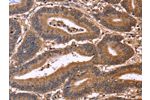 The image on the left is immunohistochemistry of paraffin-embedded Human colon cancer tissue using CSB-PA136079(CDC37L1 Antibody) at dilution 1/50, on the right is treated with fusion protein. (Original magnification: 
